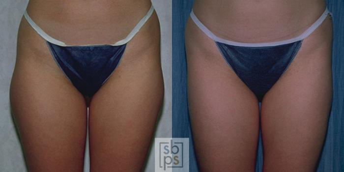 Before & After Liposuction Case 46 View #2 View in Torrance, CA