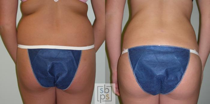 Before & After Liposuction Case 47 View #1 View in Torrance, CA
