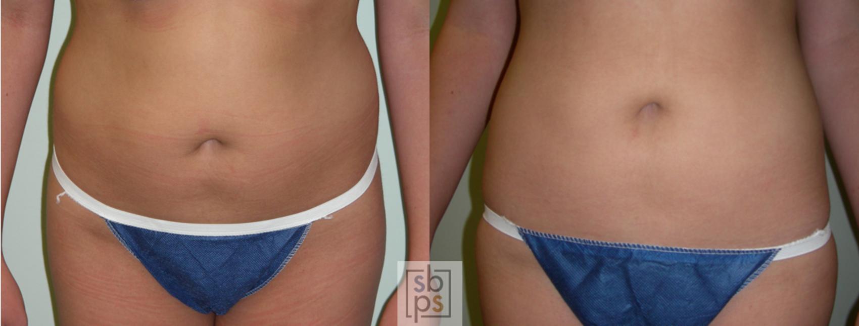 Before & After Liposuction Case 47 View #2 View in Torrance & Los Angeles, CA, CA