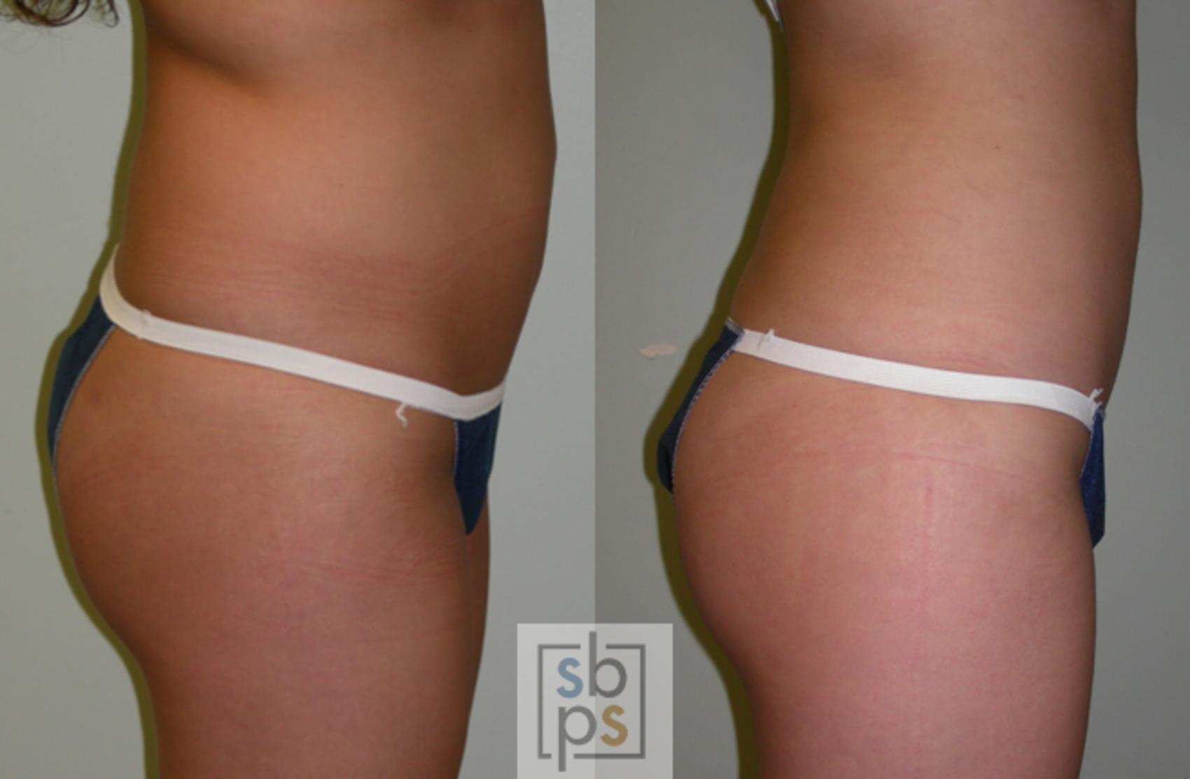 Before & After Liposuction Case 47 View #3 View in Torrance & Los Angeles, CA, CA