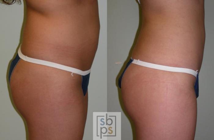 Before & After Liposuction Case 47 View #3 View in Torrance, CA