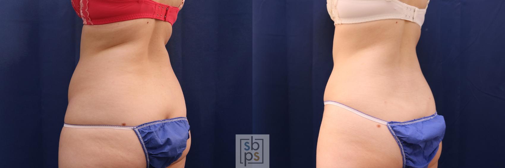 Before & After Liposuction Case 506 Left Oblique View in Los Angeles & Torrance, CA, CA