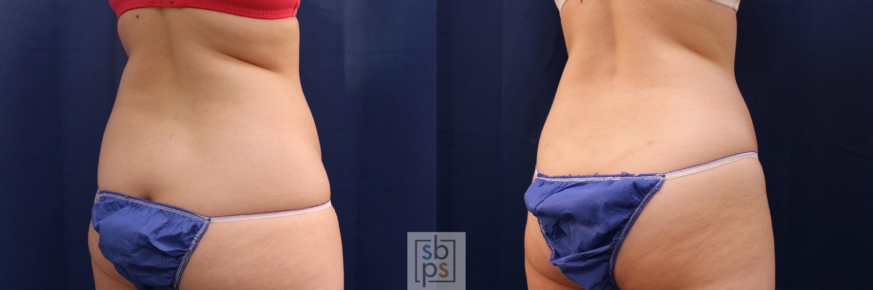 Before & After Liposuction Case 506 Right Oblique View in Torrance & Los Angeles, CA, CA