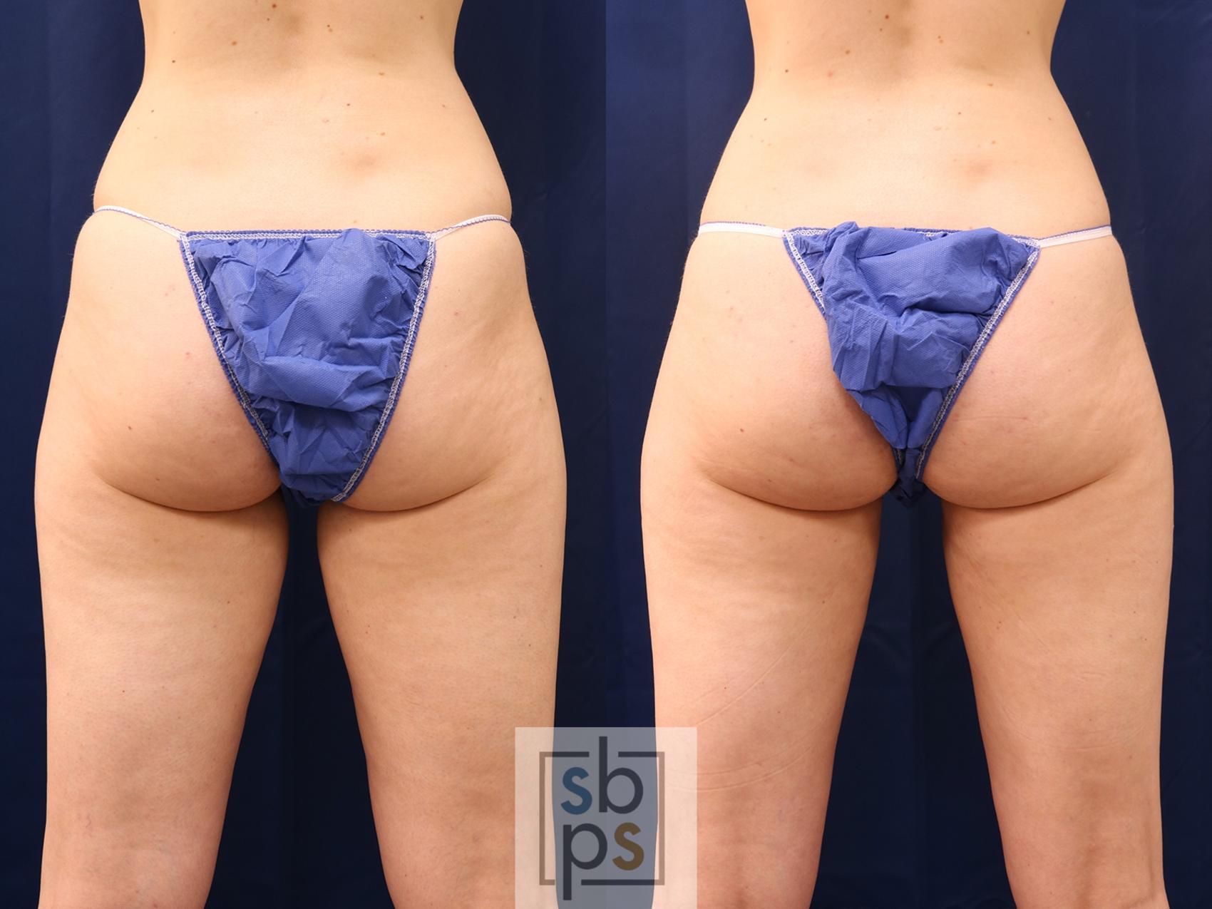 Before & After Liposuction Case 537 Back View in Torrance & Los Angeles, CA, CA