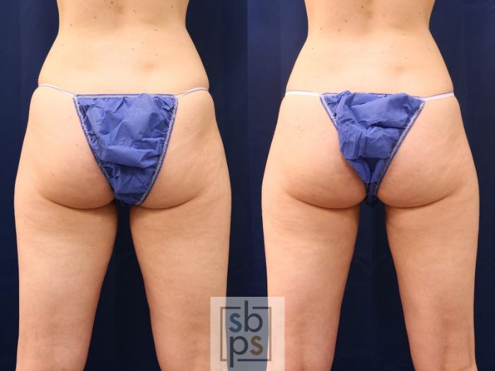 Before & After Liposuction Case 537 Back View in Torrance, CA
