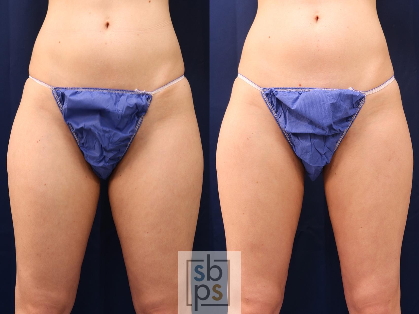 Before & After Liposuction Case 537 Front View in Torrance, CA