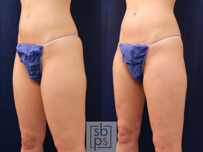 Before & After Liposuction Case 537 Left Oblique View in Torrance, CA