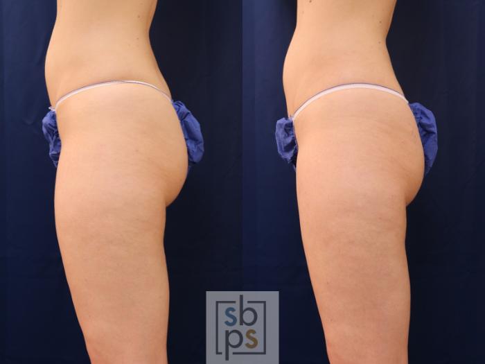 Before & After Liposuction Case 537 Left Side View in Torrance, CA