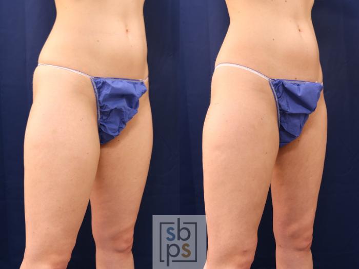 Before & After Liposuction Case 537 Right Oblique View in Torrance, CA