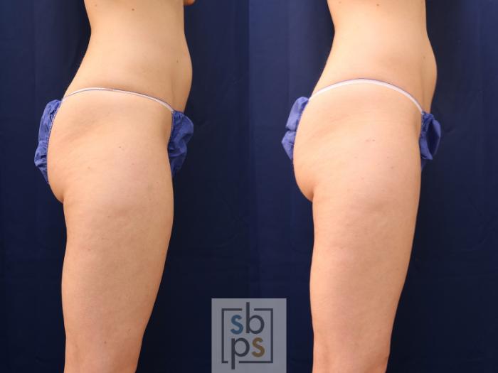 Before & After Liposuction Case 537 Right Side View in Torrance, CA