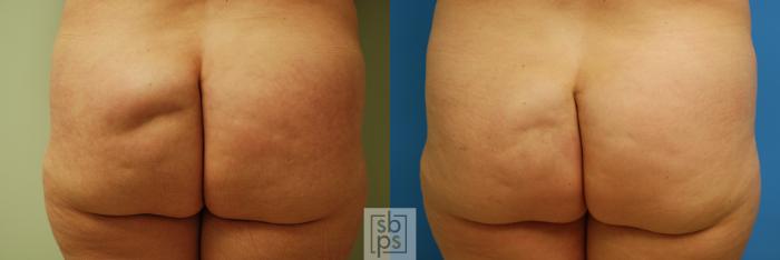 Before & After Fat Injection Case 56 View #1 View in Torrance, CA