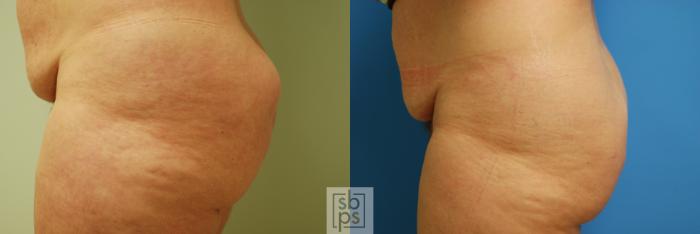 Before & After Fat Injection Case 56 View #2 View in Torrance, CA