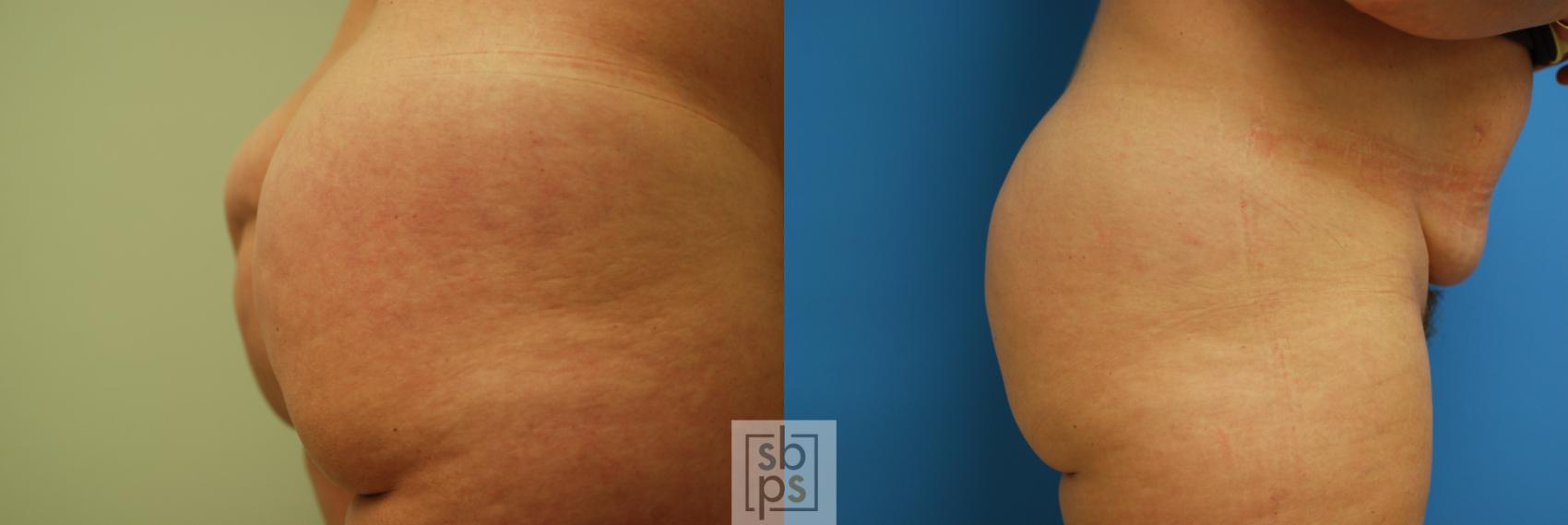 Before & After Fat Injection Case 56 View #3 View in Torrance, CA.