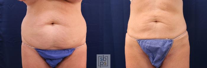 Before & After Liposuction Case 565 Front View in Torrance, CA