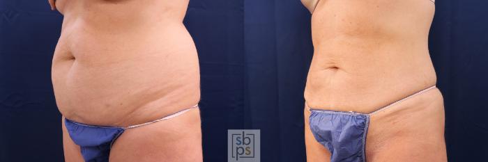 Before & After Liposuction Case 565 Left Oblique View in Torrance, CA