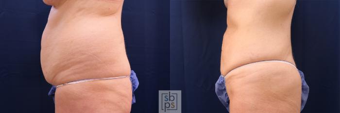 Before & After Liposuction Case 565 Left Side View in Torrance, CA
