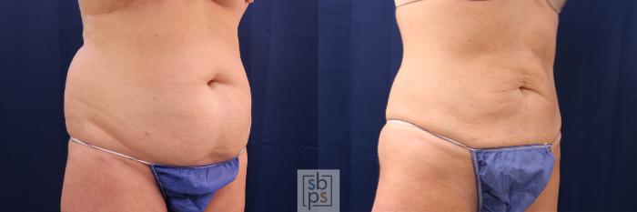 Before & After Liposuction Case 565 Right Oblique View in Torrance, CA
