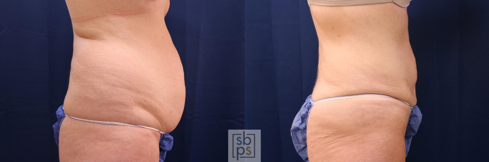 Before & After Liposuction Case 565 Right Side View in Torrance, CA