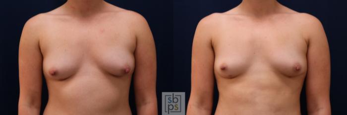 Before & After Liposuction Case 626 Front View in Torrance, CA