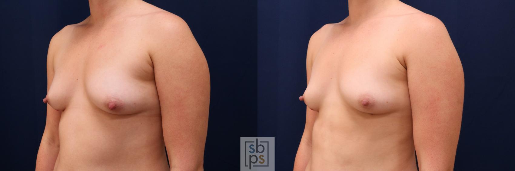 Before & After Liposuction Case 626 Left Oblique View in Torrance & Los Angeles, CA, CA