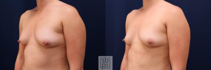 Before & After Liposuction Case 626 Left Oblique View in Torrance, CA