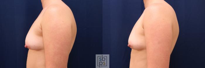 Before & After Liposuction Case 626 Left Side View in Torrance, CA