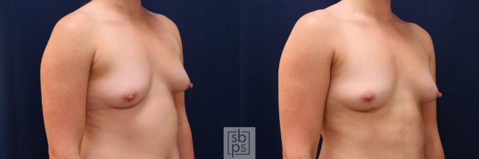 Before & After Liposuction Case 626 Right Oblique View in Torrance, CA