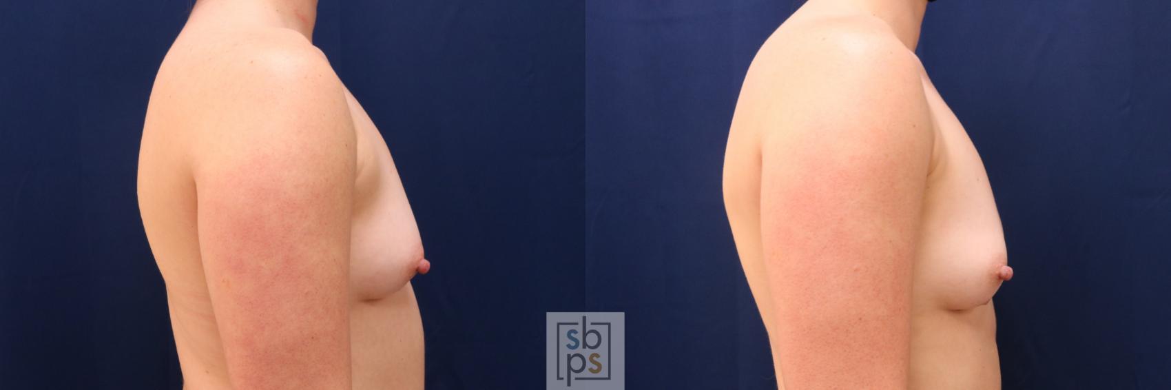 Before & After Liposuction Case 626 Right Side View in Torrance & Los Angeles, CA, CA