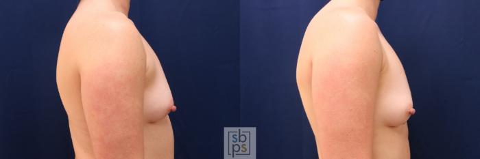 Before & After Liposuction Case 626 Right Side View in Torrance, CA