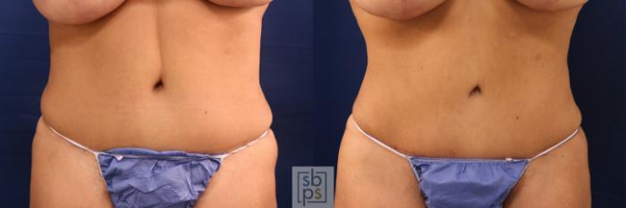 Before & After Liposuction Case 649 Front View in Torrance, CA