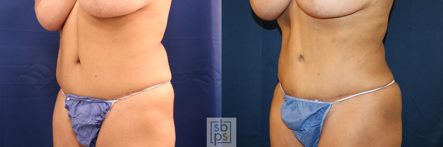 Before & After Liposuction Case 649 Left Oblique View in Torrance & Los Angeles, CA, CA