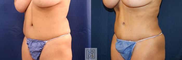 Before & After Liposuction Case 649 Left Oblique View in Torrance, CA