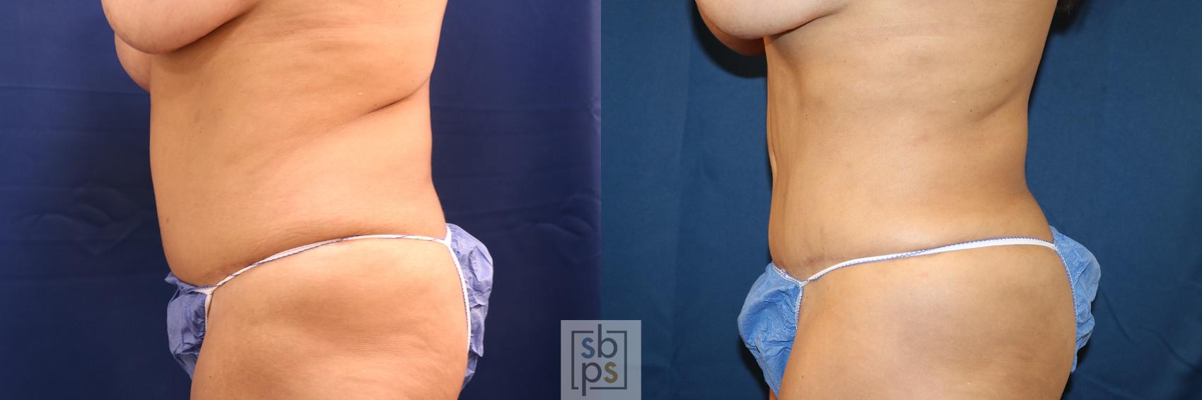 Before & After Liposuction Case 649 Left Side View in Torrance & Los Angeles, CA, CA