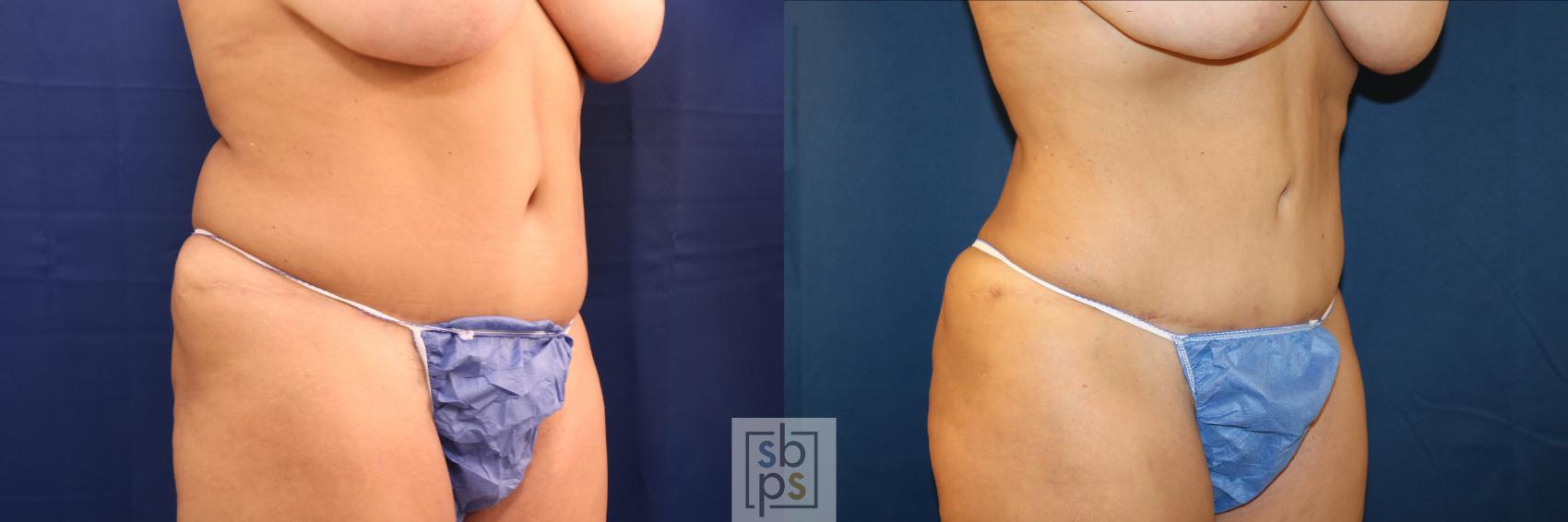 Before & After Liposuction Case 649 Right Oblique View in Torrance & Los Angeles, CA, CA