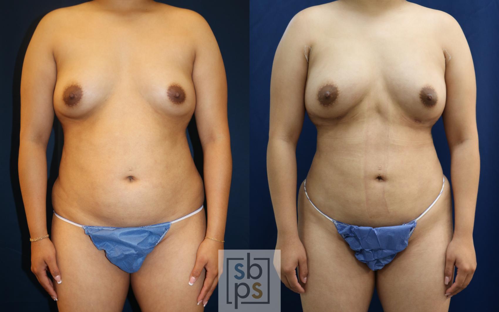 Before & After Breast Augmentation Case 667 Front View in Torrance, CA