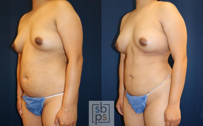 Before & After Breast Augmentation Case 667 Left Oblique View in Torrance, CA