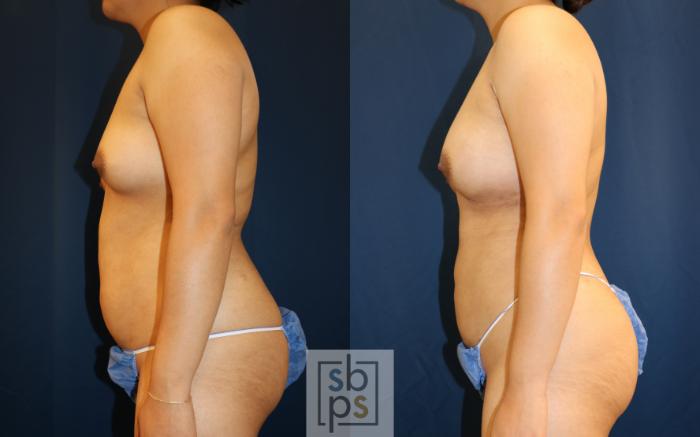 Before & After Liposuction Case 667 Left Side View in Torrance, CA