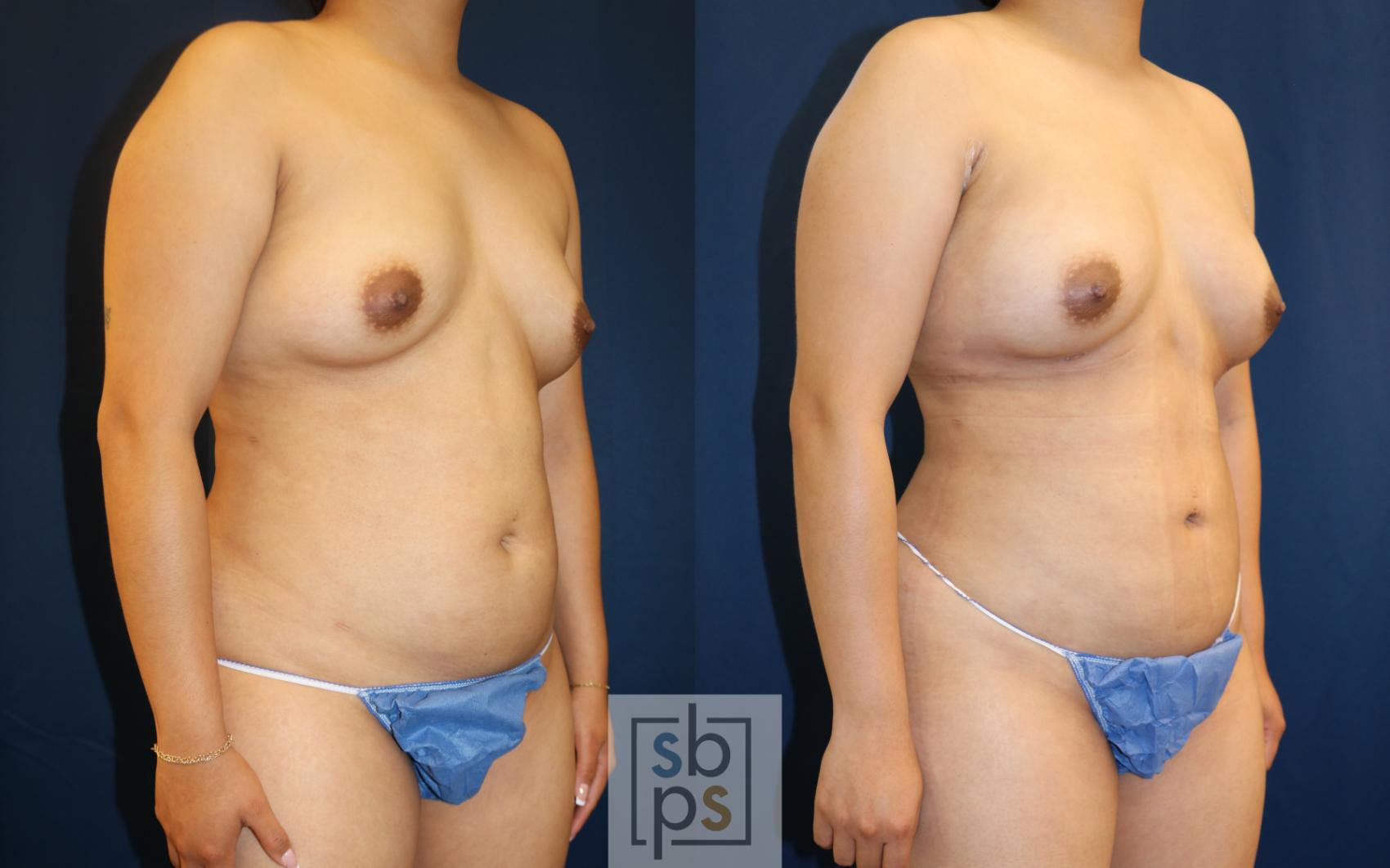 Before & After Liposuction Case 667 Right Oblique View in Torrance & Los Angeles, CA, CA