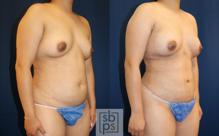 Before & After Breast Augmentation Case 667 Right Oblique View in Torrance, CA
