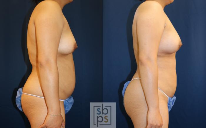 Before & After Breast Augmentation Case 667 Right Side View in Torrance, CA