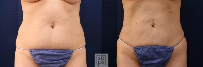 Before & After Liposuction Case 675 Front View in Torrance, CA