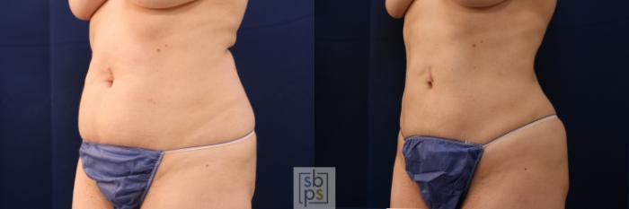 Before & After Liposuction Case 675 Left Oblique View in Torrance, CA