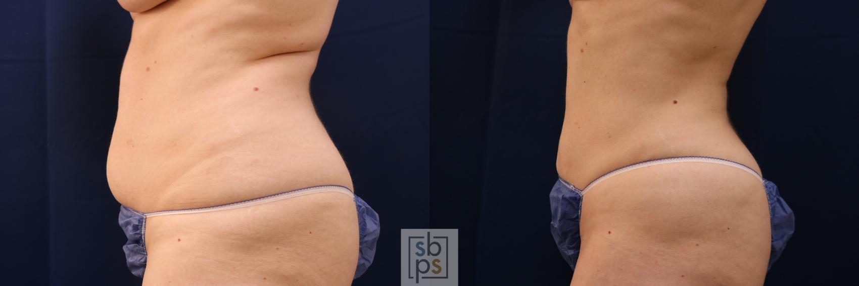 Before & After Liposuction Case 675 Left Side View in Torrance & Los Angeles, CA, CA