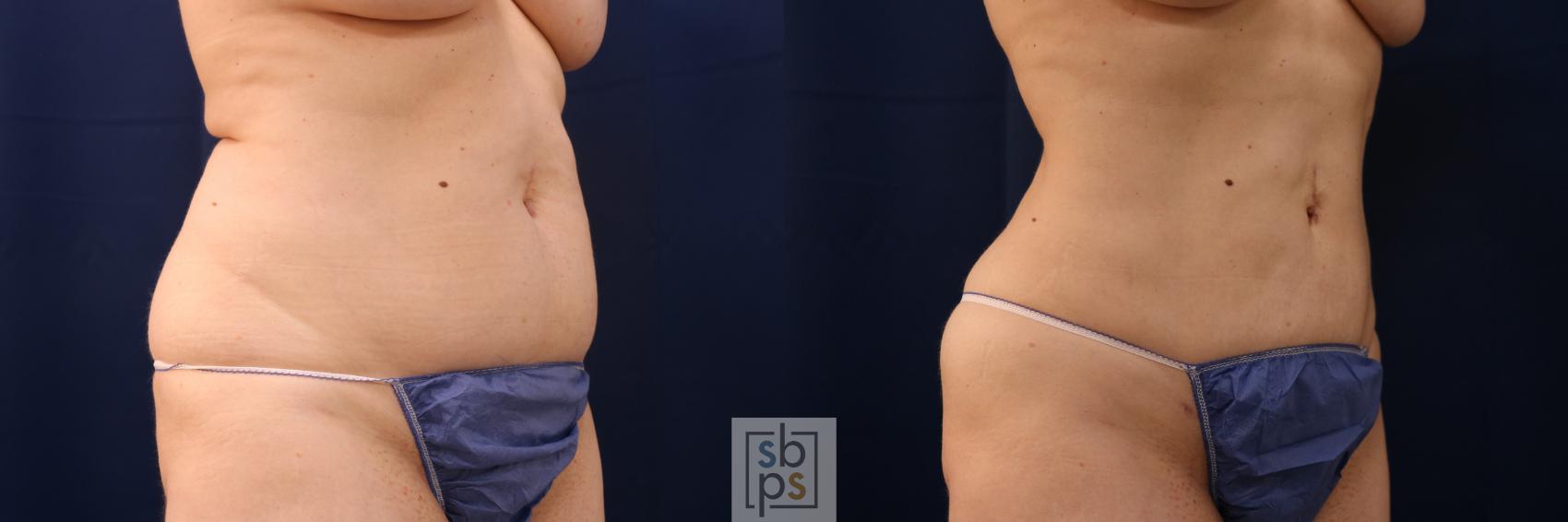 Before & After Liposuction Case 675 Right Oblique View in Torrance & Los Angeles, CA, CA