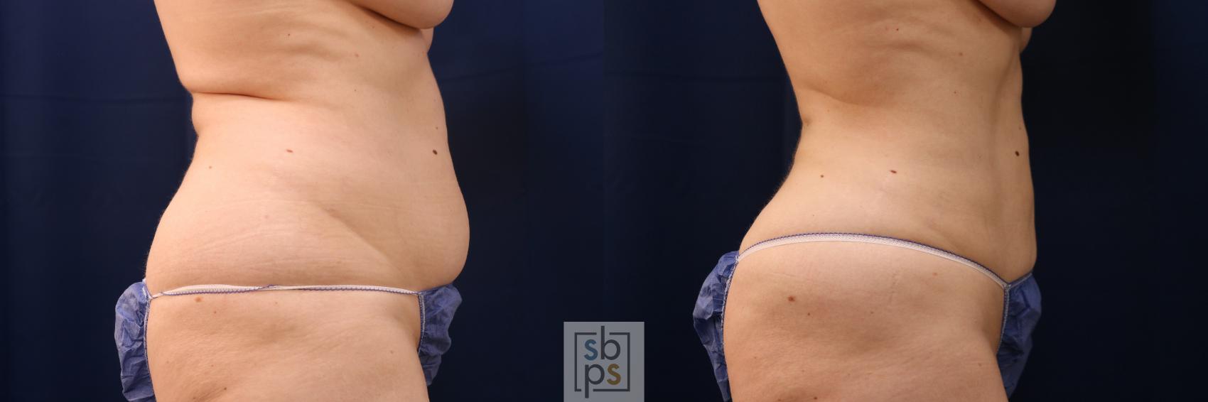 Before & After Liposuction Case 675 Right Side View in Torrance & Los Angeles, CA, CA