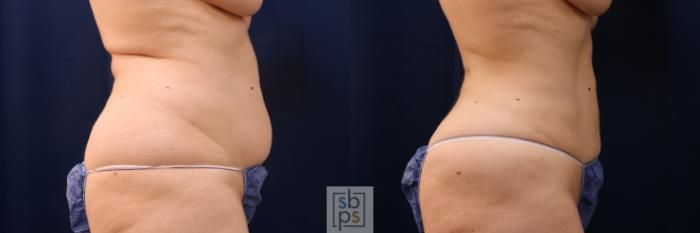 Before & After Liposuction Case 675 Right Side View in Torrance, CA