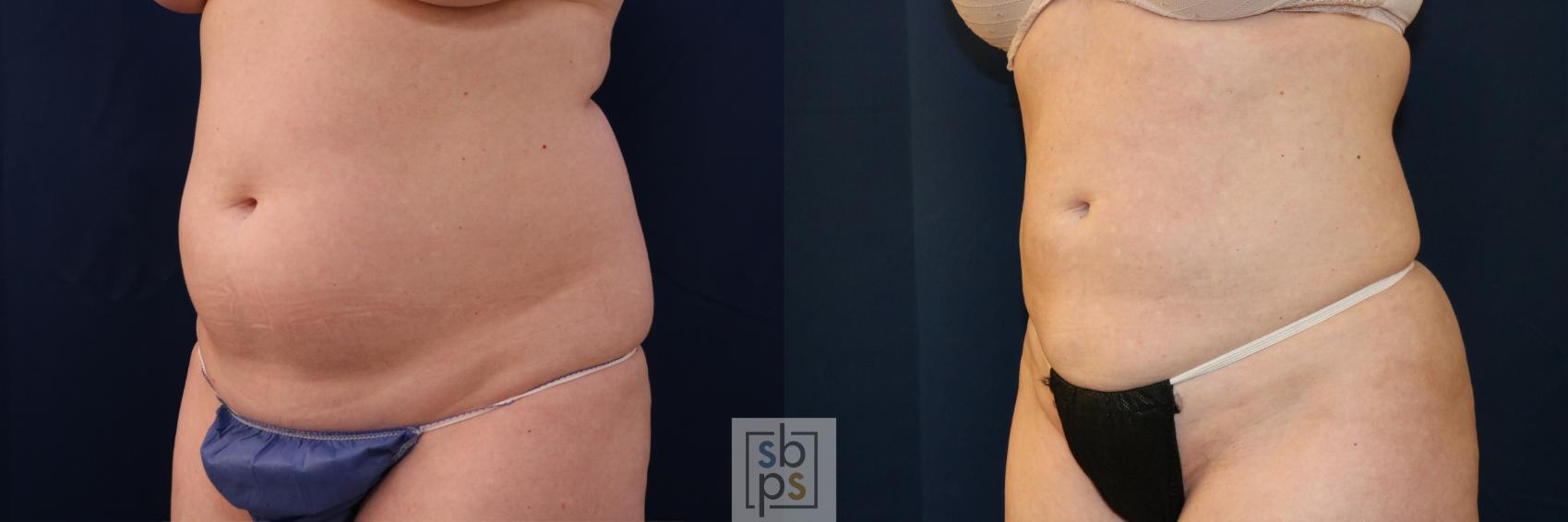 Before & After Liposuction Case 683 Left Oblique View in Torrance & Los Angeles, CA, CA