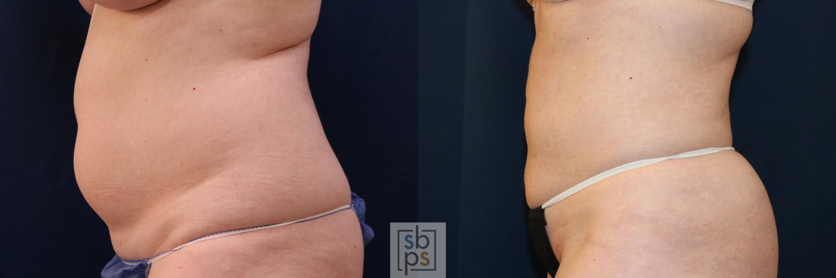 Before & After Liposuction Case 683 Left Side View in Torrance & Los Angeles, CA, CA