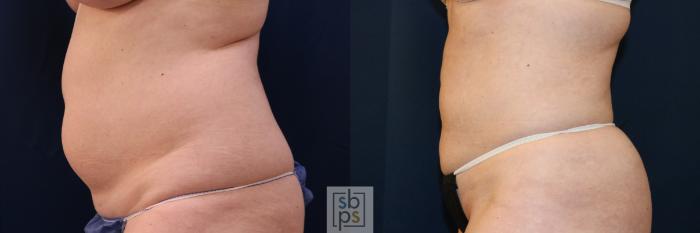 Before & After Liposuction Case 683 Left Side View in Torrance, CA