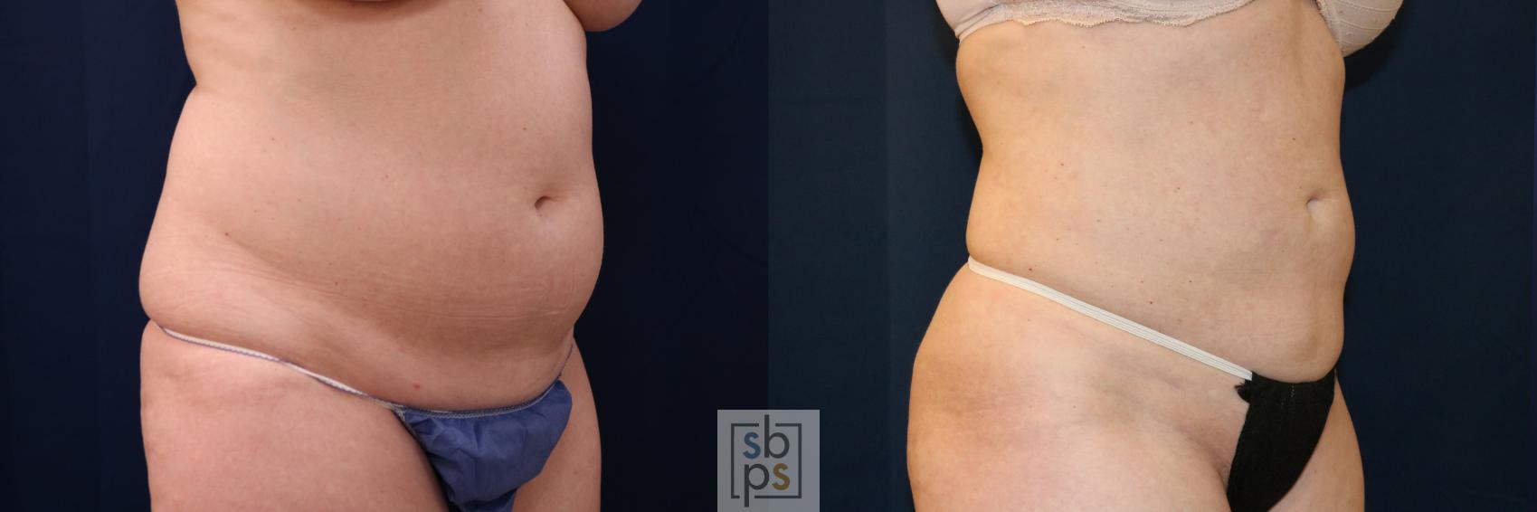 Before & After Liposuction Case 683 Right Oblique View in Torrance & Los Angeles, CA, CA
